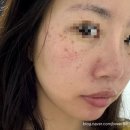 루비약국 | 루나의원 루비레이저 내돈내산 후기 (일년 후기도 있음)