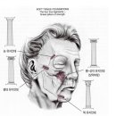 주름제거수술 안면거상술 부터 목거상술까지 이미지
