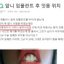 온디맨드치과기공소 | 삼성동치과 앞니 임플란트 가격만 보다가 놓치는 이것? <실제 사례>