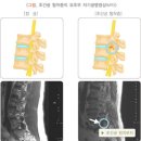 [출똥] -척추관협착증 증상 10가지 정리 이미지