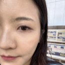 더블로 아이 눈가 리프팅 효과 최고!부평 피부과 더블로 리프팅 후기 내돈내산