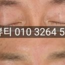 고은하늘성형외과 네이버블로그