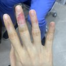 손가락 심재성 2도 화상 치료 및 실비 보험 (화상진단금) 청구 후기