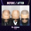 디비전 스칼프 | 수원삭발두피문신 가격과 퀄리티를 다 잡은 곳