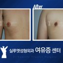 여유증 수술 유륜도 줄어들까? 이미지