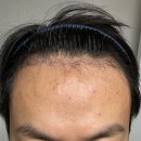 모바른한상보의원 | [후기] 남자 비절개 2,500모 모발이식 (모바른한상보)