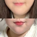 부산 대연동 경성대 피부과 대웅제약 브이올렛 주사 효과 후기
