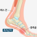 족저근막염, 발바닥 통증이 있으신 분은 필독 이미지