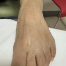 D00143 | 무지외반증 수술 후기, 수술 후13년 째. 최소침습 수술이 좋나요? 기존의 개방수술이 좋나요?