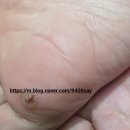 곤케어 | 셀메드 사마곤 크림으로 발바닥 사마귀 티눈 고민 해결한 후기