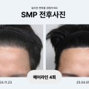 영등포두피문신 M자 정수리 헤어라인 탈모커버 잘하는 곳 찾는다면?