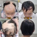미소산약국 | 지루성두피염, 탈모 | 미소산 두 달 복용 후기