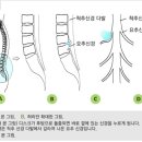 허리디스크란?? 이미지