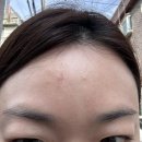 자연담한의원 | 합정 피부과 한의원 방문기! 이마 패인흉터 제거를 위한 새살침 치료 4회차 후기