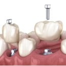 다이아몬드치과기공소 이미지