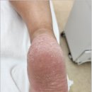 레푸스 봉담점 | 수원 봉담 발각질 제거는 레푸스 호매실점이 최고
