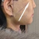 LK성형외과의원 | 광주 브이라인 안면거상 재수술 6일, 10일 후기 전후사진 필요