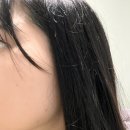 안피부과의원 | 신길동 피부과 안톤의원 시술후기