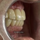 안산레이크치과의원 | [안산레이크치과] 전체 임플란트, 전악 임플란트 케이스입니다