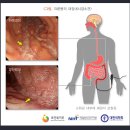 갱신형 크론병및궤양성대장염진단비보장 특별약관 (크론병및궤양성대장염의 정의 및 진단확정) 이미지