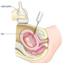 양수 검사[amniocentesis] 이미지