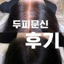 마이크로짐 | 강남 두피문신 마이크로청담 3회 솔직 후기