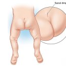 딤플