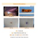 만성담낭염수술후기. 하루 일정이어서 지금 뭐가 어떻다 하기에는 이른감이 있지만 생각했던 것 보다는 많이 개선되어 수원해진 시술... 이미지