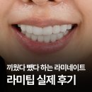 ORA부산치과기공소 | 내돈내산 부산라미네이트 솔직후기! 치아 삭제 없는 라미팁