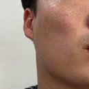 생각하는사람들 | 화성동탄 근처 오산 얼굴전체 편평사마귀 점제거 후기