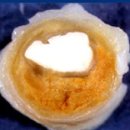 급성심근경색증 (Acute Myocardial Infarction) 이미지