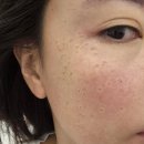 주엽역(3호선) | 주엽역뷰티 엔라인&amp;풀닷 검버섯 기미 잡티 관리받고 왔어요
