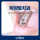 득량동치과 충치치료는 시기와 타이밍이 중요해요