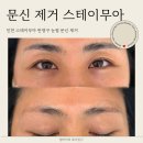 무아 | 인천 눈썹문신제거 잘하는 곳, 스테무아 솔직 후기