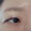 아이라인 문신제거 1차 후기