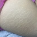 콤플렉스 극복기 | 안양 튼살커버전문점 일루젼스칼프에서 튼살커버 받고 온 솔직 후기 [1회차]