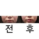 전후사진有 내돈내산 메디큐브 에이지알 울트라튠 40.68 하이포커스샷 부스터프로 쿠로미에디션 솔직후기