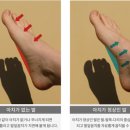 기운메디칼 | 풋메디칼 기능성 아치 깔창 오다리 보정템