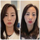 지축지구 | 지축피부과 써마지같은 효과 통증없는 쿨페이즈 600샷 효과 일주일 후기