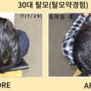 동명헤어라인 이미지