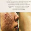 더 피앤피 | 광주피부관리 받으러 다녀온 피앤피뷰티연구소 후기 (여드름흉터 관리기록)