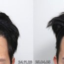 서강초교 | 합정두피문신, 궁금증 모두 해결해드립니다 (모발이식, 가격, 유지기간, 부작용, 후기)