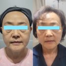 이미지업의원 | 60대 교회 권사님의 실리프팅 후기