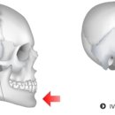 주걱턱, 안면비대칭, 개방교합, 긴얼굴 양상을 모두 보이는 얼굴의 턱교정 수술 이미지