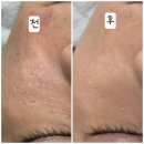 슈어메디칼 | [대전 문지동 피부관리샵] 피부향기: 로제필X플라리온으로 완성하는 깐달걀 피부