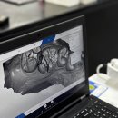 3D치과기공소 | 천안충치치료 레진vs인레이vs크라운 치료법 3가지
