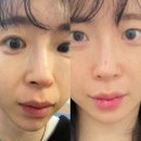 하이의원 | 선릉역 슈덴하이리프팅 맑은선의원 재방문 솔직후기 l 슈링크+덴서티 하이 시술후기