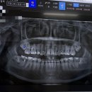 세방치과의원 | 필력 뒤지는 죽지 않고 돌아온 누운 사랑니 발치 생생한 후기