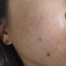 고원장의모공세척테라피구월점 | 시흥 피부관리 고원장의모공세척테라피 방문 후기 트러블관리에 도움됨
