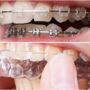 김영재의원 | 돌출입수술 비용 입툭튀원인 교정 후기 병원